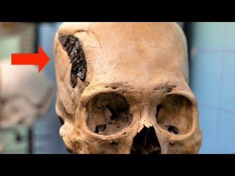 Impianto metallico del cranio peruviano
